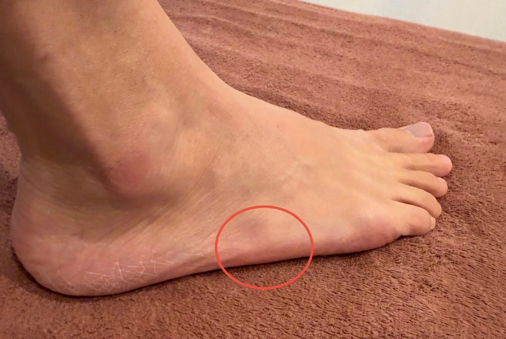 イズリン病(Iselin病)