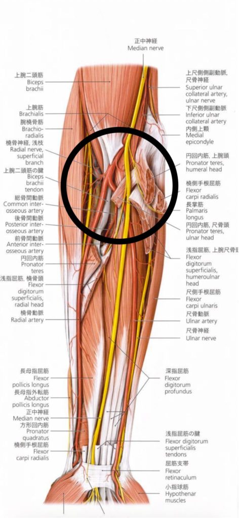 円回内筋症候群